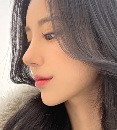 Revision Rhino plasty