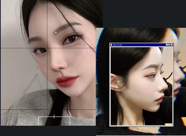 Revision Rhino plasty